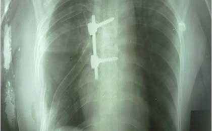TB Spine