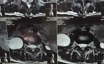TB Spine