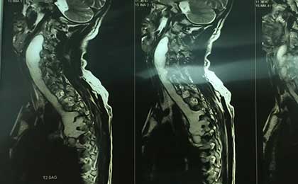 TB Spine