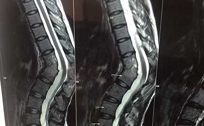 TB Spine