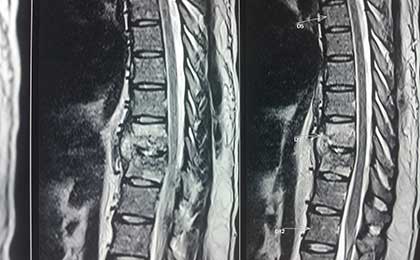 TB Spine