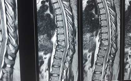 TB Spine