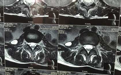TB Spine