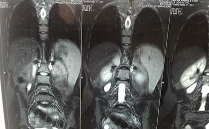 TB Spine