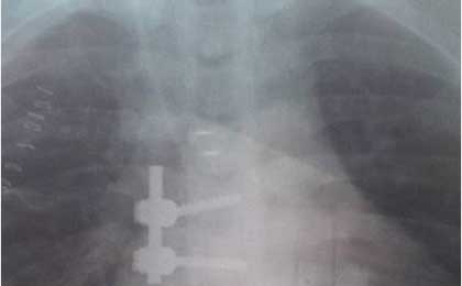 Traumatic Spine Injury
