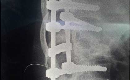 Traumatic Spine Injury