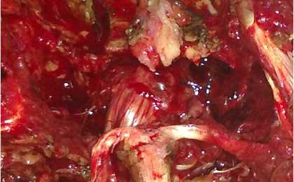 Traumatic Spine Injury
