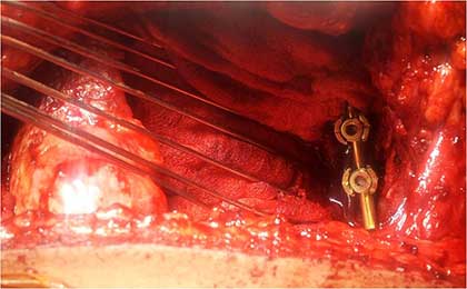 Traumatic Spine Injury
