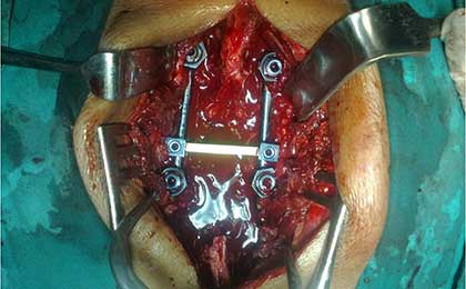 Traumatic Spine Injury