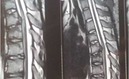 Traumatic Spine Injury