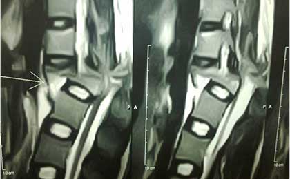 Traumatic Spine Injury
