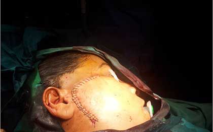 Trigeminal Neuralgia