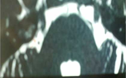 Trigeminal Neuralgia