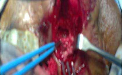 Trigeminal Neuralgia