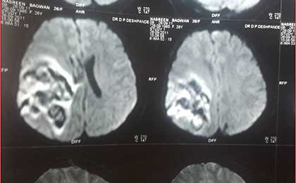 Venous Infarct Brain