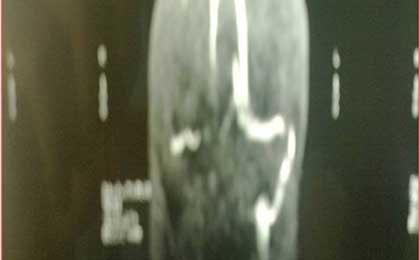 Venous Infarct Brain