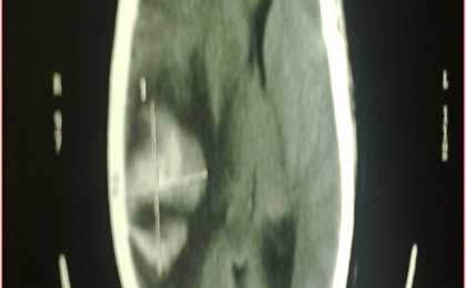 Venous Infarct Brain