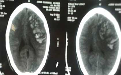Venous Infarct Brain