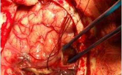 Venous Infarct Brain