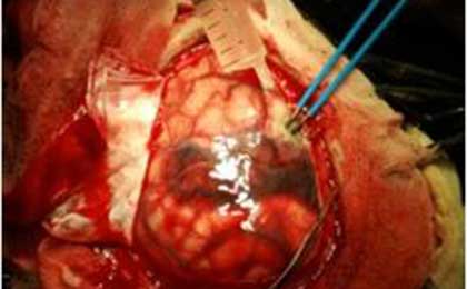 Venous Infarct Brain
