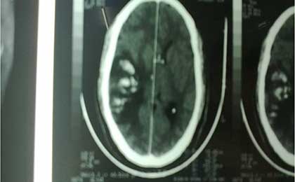 Venous Infarct Brain