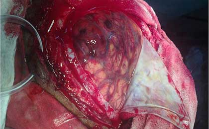 Venous Infarct Brain