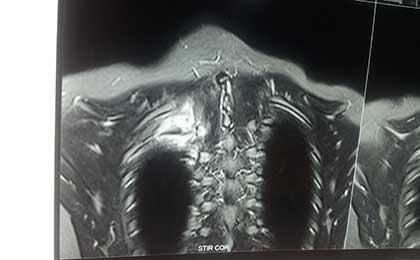 Vertebral Tumors