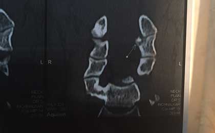 Vertebral Tumors