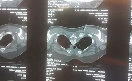 Vertebral Tumors