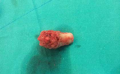 Vertebral Tumors