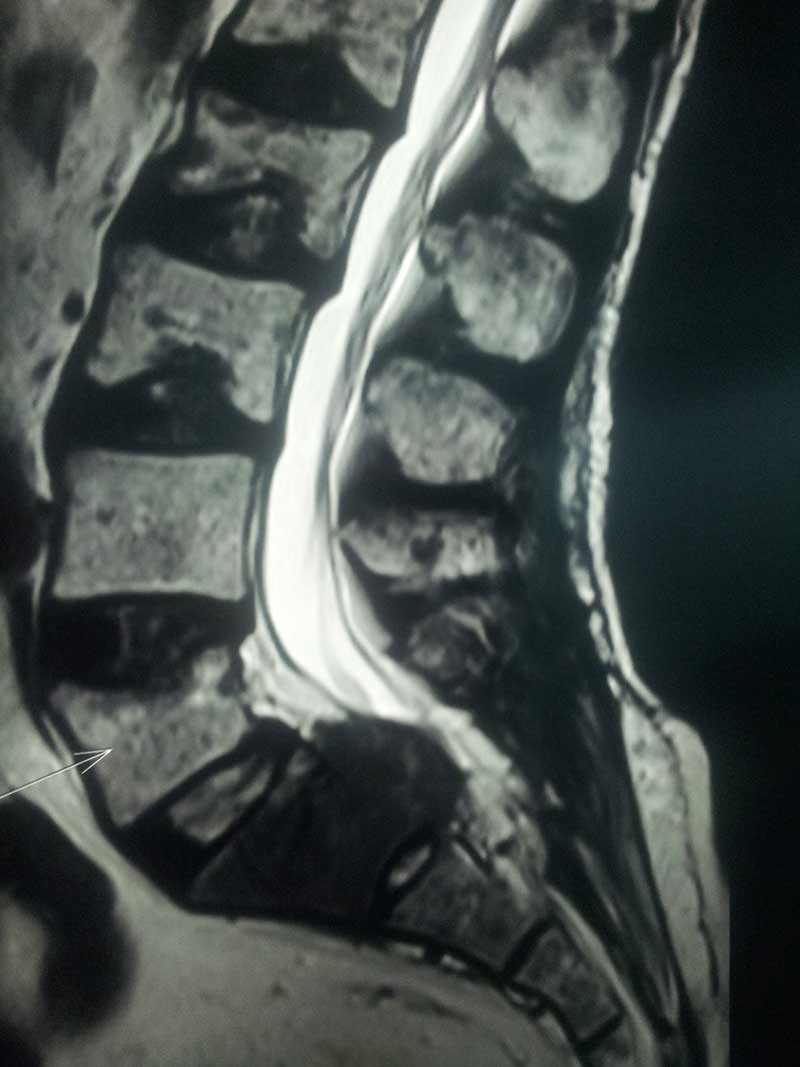 Vertebral Tumors